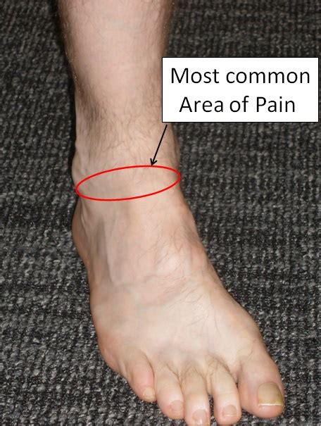 rt ankle pain icd 10